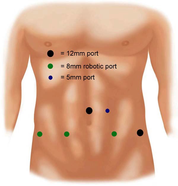 Posicionamento das incisões na prostatectomia radical robótica — 5 a 6 pequenas incisões de 8 a 12mm